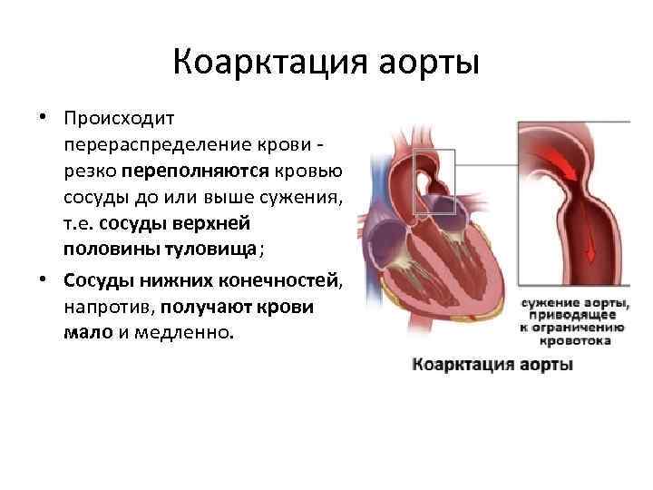 Коарктация аорты картинки