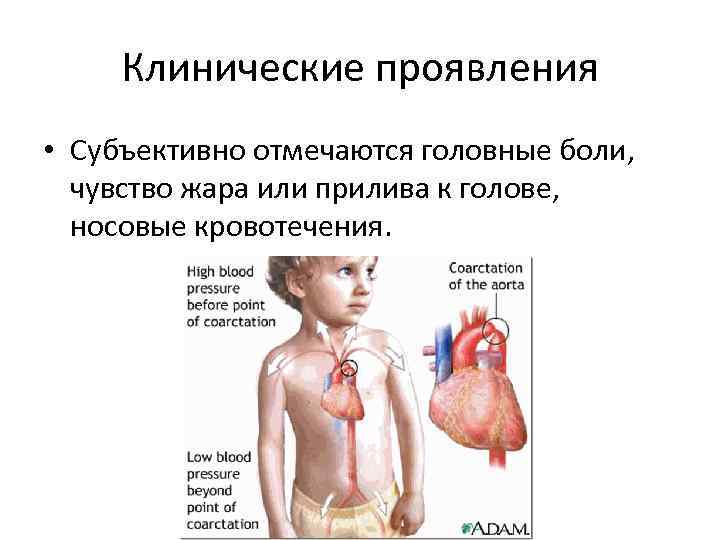 Клинические проявления • Субъективно отмечаются головные боли, чувство жара или прилива к голове, носовые