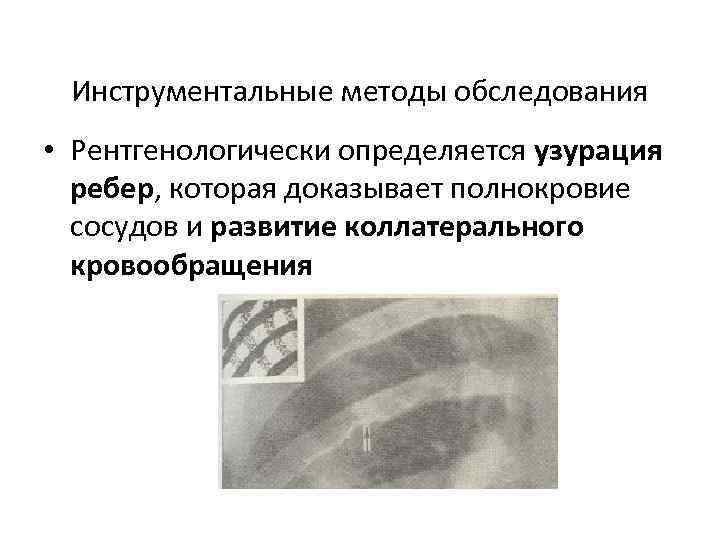  Инструментальные методы обследования • Рентгенологически определяется узурация ребер, которая доказывает полнокровие сосудов и