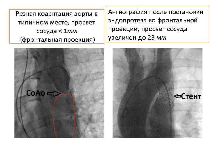 Резкая коарктация аорты в типичном месте, просвет сосуда < 1 мм (фронтальная проекция) Ангиография