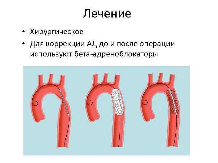 Лечение • Хирургическое • Для коррекции АД до и после операции используют бета-адреноблокаторы 