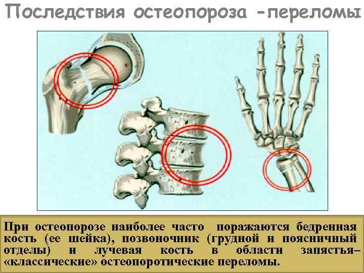 Последствия остеопороза -переломы При остеопорозе наиболее часто поражаются бедренная кость (ее шейка), позвоночник (грудной