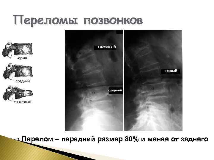 Переломы позвонков • Перелом – передний размер 80% и менее от заднего 