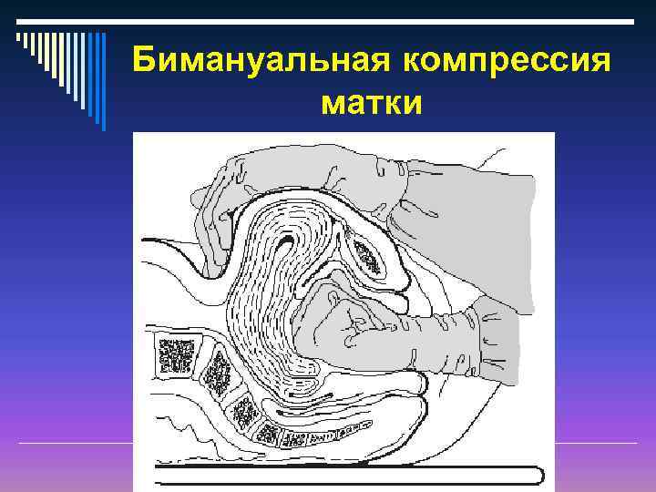 Бимануальное влагалищное исследование. Бимануальной компрессии матки. Бимануальное сдавливание матки. Бимануальная компрессия матки. Бимануальное исследование шейки матки.