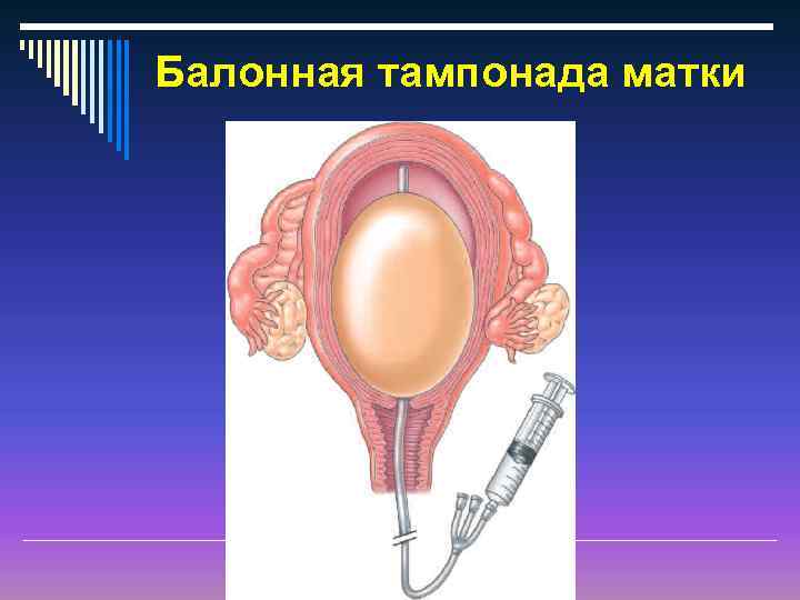 Баллонная тампонада матки презентация