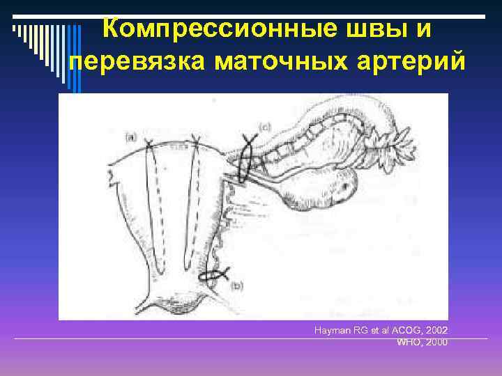 Перевязка маточных сосудов. Перевязка магистральных маточных сосудов. Перевязка восходящих ветвей маточных артерий. Перевязка маточно-яичниковых сосудов.