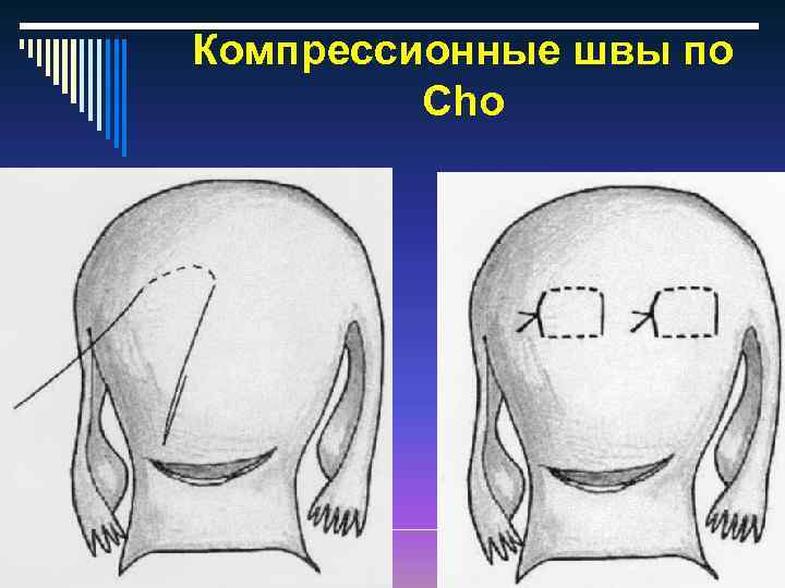 Компрессионные швы по Cho 