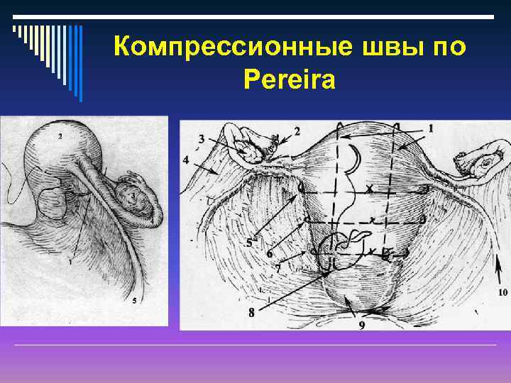 Компрессионные швы по Pereira 