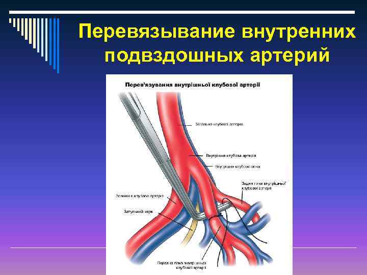 Перевязка маточных сосудов. Операция перевязка внутренних подвздошных артерий. Лигирование внутренних подвздошных артерий. Перевязка подвздошных артерий Акушерство. Перевязка внутренней подвздошной артерии.