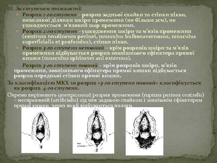 ІІІ. За ступенем тяжкості: Розрив 1 -го ступеня – розрив задньої спайки та стінки