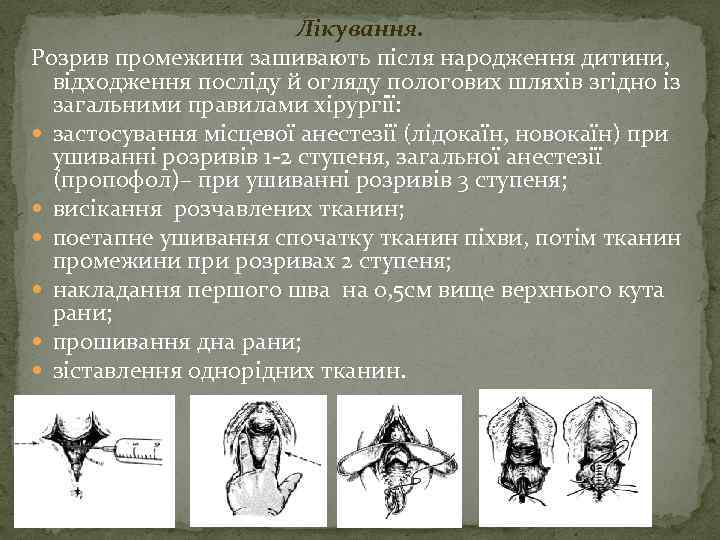 Лікування. Розрив промежини зашивають після народження дитини, відходження посліду й огляду пологових шляхів згідно