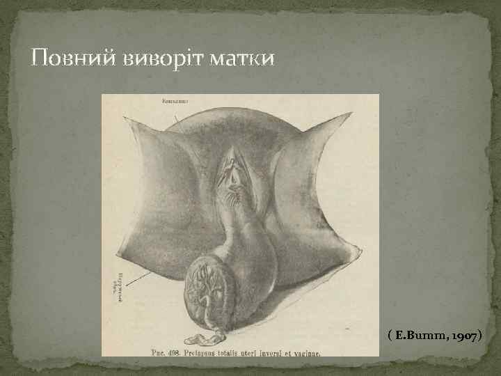 Повний виворіт матки ( Е. Bumm, 1907) 