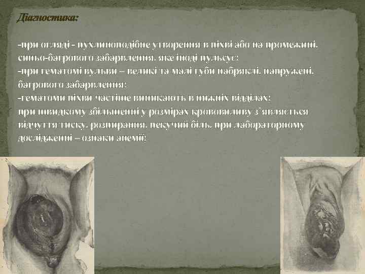 Діагностика: -при огляді - пухлиноподібне утворення в піхві або на промежині, синьо-багрового забарвлення, яке