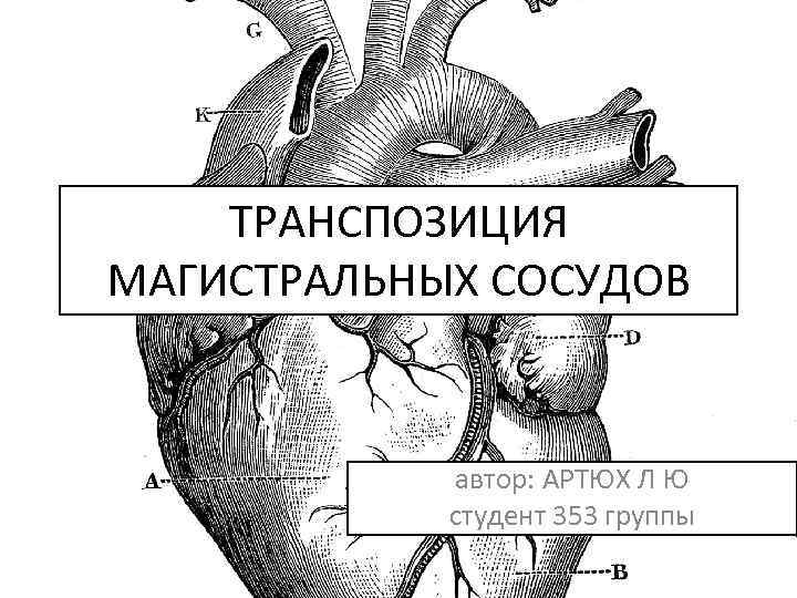 ТРАНСПОЗИЦИЯ МАГИСТРАЛЬНЫХ СОСУДОВ автор: АРТЮХ Л Ю студент 353 группы 