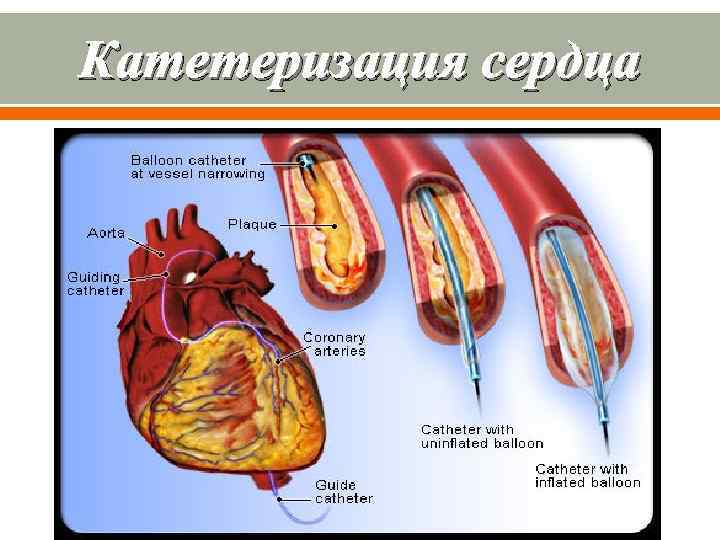 Катетеризация сердца 