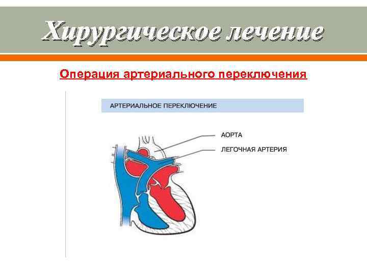 Хирургическое лечение Операция артериального переключения 