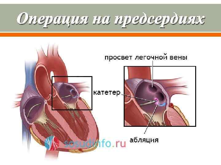 Операция на предсердиях 