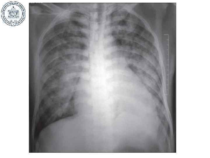 А что, если все легкое негомогенно? . . . 