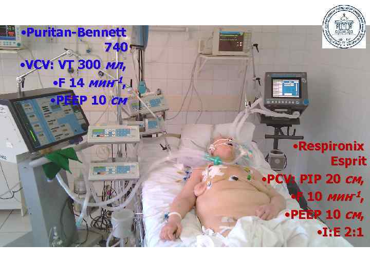  • Puritan-Bennett 740 • VCV: VT 300 мл, • F 14 мин-1, •