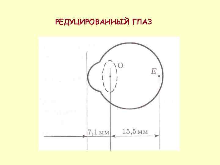 РЕДУЦИРОВАННЫЙ ГЛАЗ 