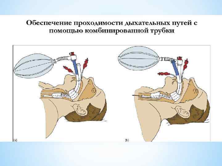 Проведение проходимости дыхательных путей