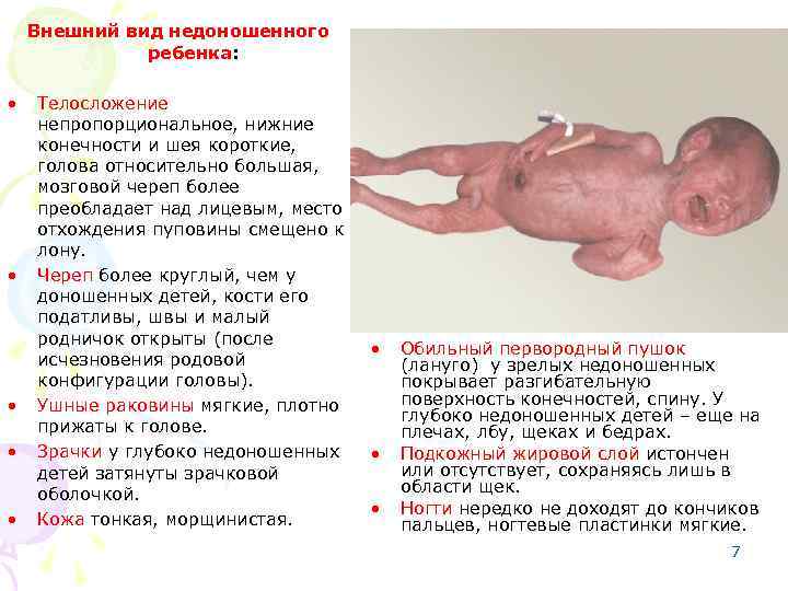 Внешний вид недоношенного ребенка: • • • Телосложение непропорциональное, нижние конечности и шея короткие,