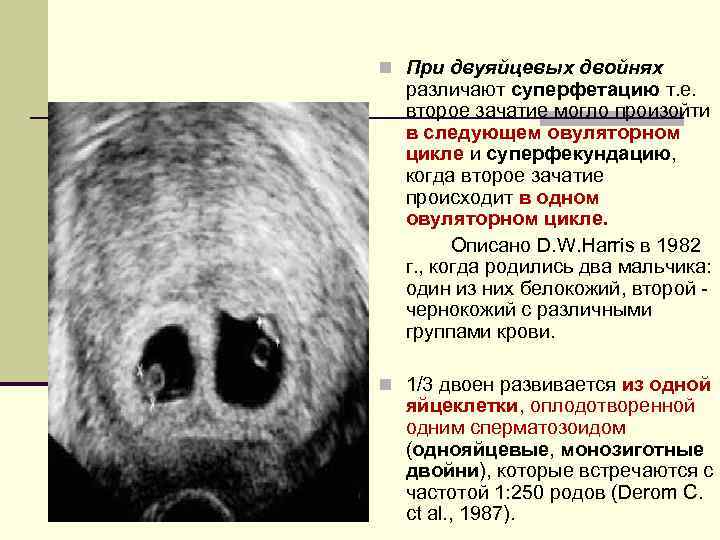 n При двуяйцевых двойнях различают суперфетацию т. е. второе зачатие могло произойти в следующем