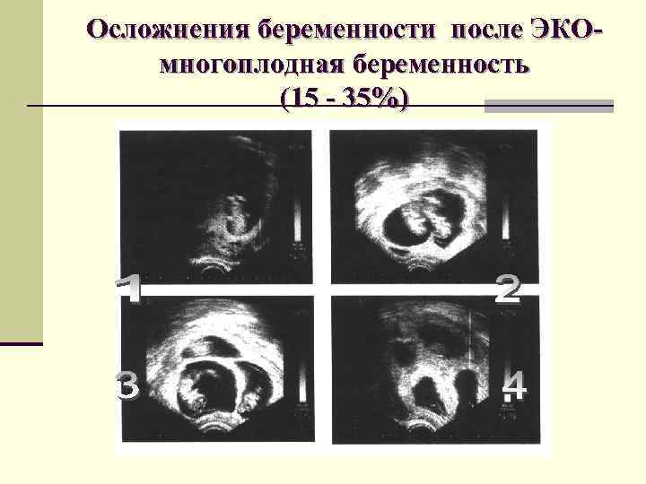 Осложнения беременности после ЭКОмногоплодная беременность (15 - 35%) 