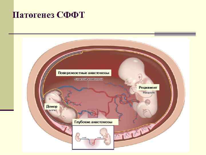 Патогенез СФФТ Поверхнеостные анастомозы Реципиент Донор Глубокие анастомозы 