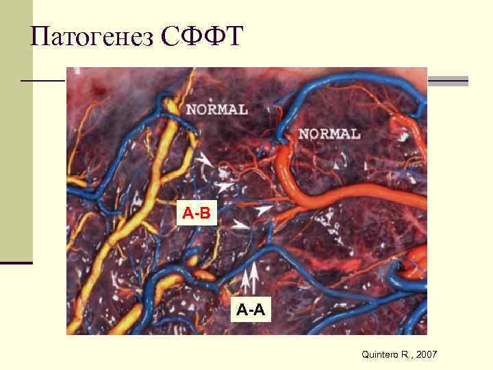 Патогенез СФФТ А-В А-А Quintero R. , 2007 