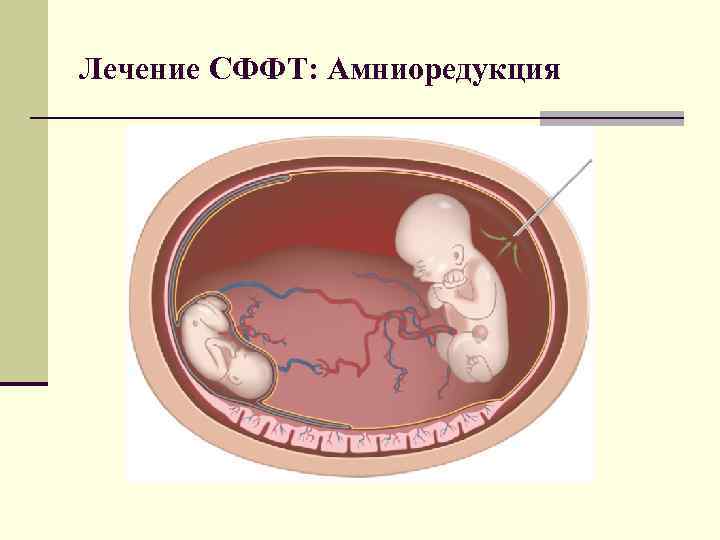 Лечение СФФТ: Амниоредукция 