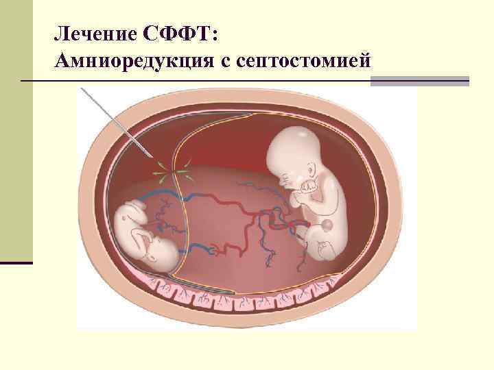 Лечение СФФТ: Амниоредукция с септостомией 