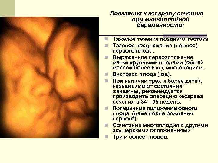 Показания к кесареву сечению при многоплодной беременности: n Тяжелое течение позднего гестоза n Тазовое