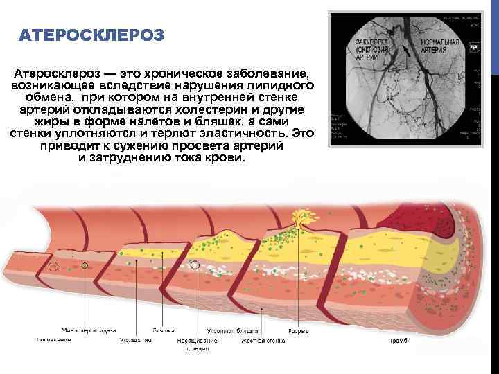 АТЕРОСКЛЕРОЗ Атеросклероз — это хроническое заболевание, возникающее вследствие нарушения липидного обмена, при котором на