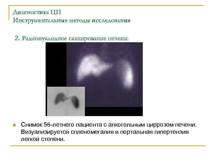 Диагностика ЦП Инструментальные методы исследования 2. Радионуклидное сканирование печени. n Снимок 56 -летнего пациента