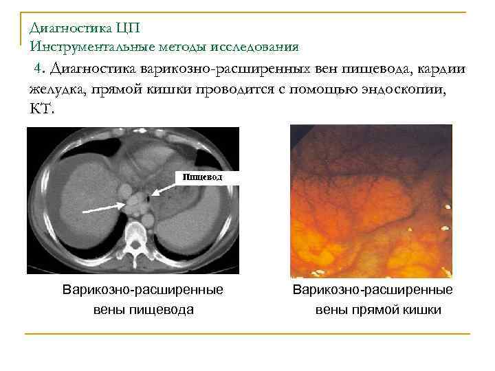Диагностика ЦП Инструментальные методы исследования 4. Диагностика варикозно-расширенных вен пищевода, кардии желудка, прямой кишки