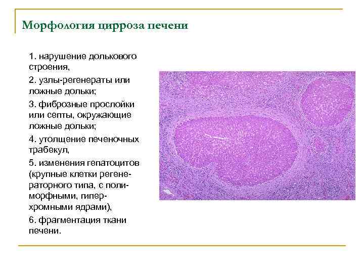Морфология цирроза печени 1. нарушение долькового строения, 2. узлы-регенераты или ложные дольки; 3. фиброзные