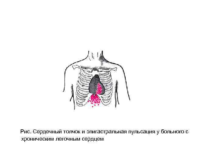  Рис. Сердечный толчок и эпигастральная пульсация у больного с хроническим легочным сердцем 