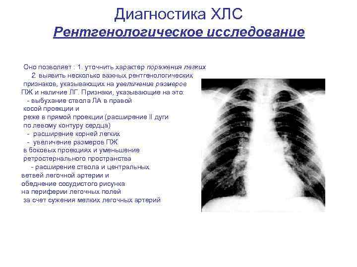Диагностика ХЛС Рентгенологическое исследование Оно позволяет : 1. уточнить характер поражения легких 2. выявить