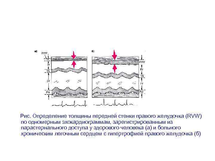  Рис. Определение толщины передней стенки правого желудочка (RVW) по одномерным эхокардиограммам, зарегистрированным из