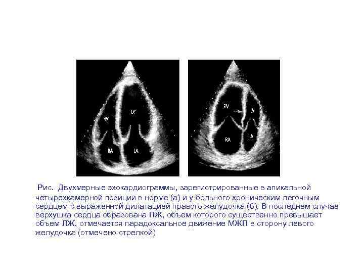  Рис. Двухмерные эхокардиограммы, зарегистрированные в апикальной четырехкамерной позиции в норме (а) и у