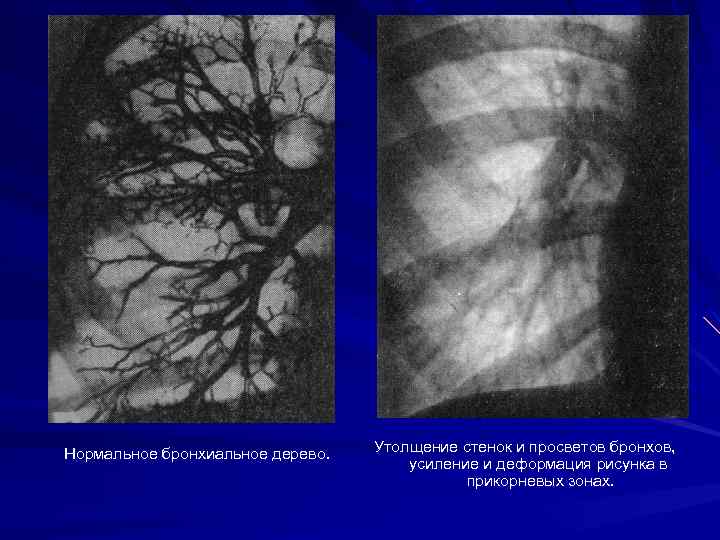 Нормальное бронхиальное дерево. Утолщение стенок и просветов бронхов, усиление и деформация рисунка в прикорневых