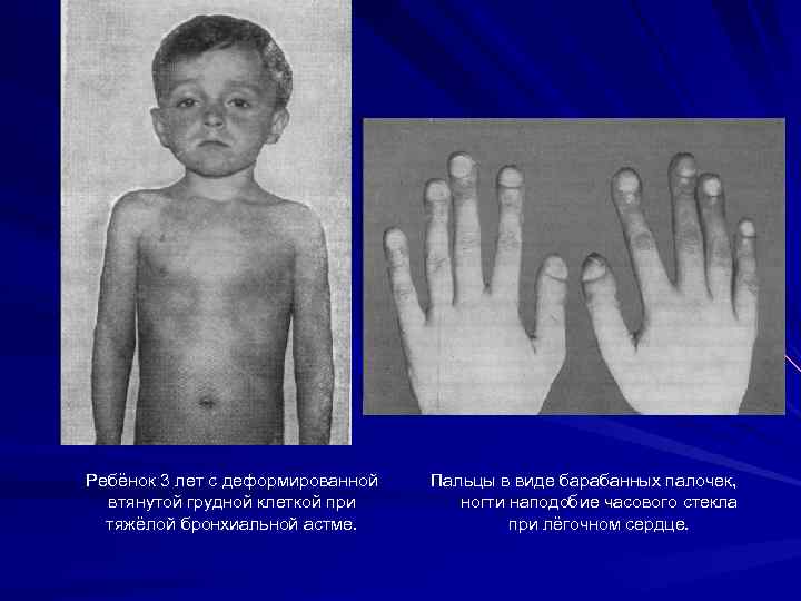  Ребёнок 3 лет с деформированной втянутой грудной клеткой при тяжёлой бронхиальной астме. Пальцы