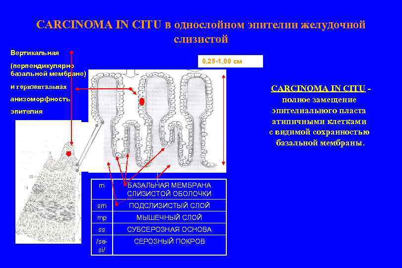 CARCINOMA IN CITU в однослойном эпителии желудочной слизистой Вертикальная 0, 25 -1, 00 см