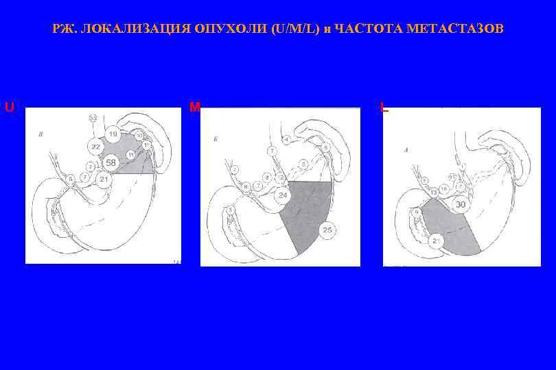 РЖ. ЛОКАЛИЗАЦИЯ ОПУХОЛИ (U/M/L) и ЧАСТОТА МЕТАСТАЗОВ U M L 