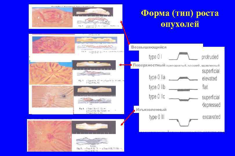 Форма роста. Типы роста опухолей. Различных форм опухолей. Вид опухолей при различных формах роста.