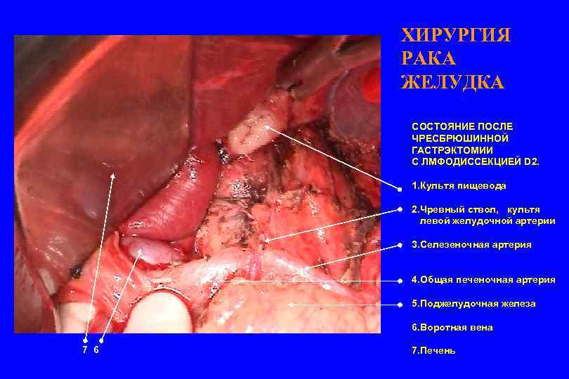ХИРУРГИЯ РАКА ЖЕЛУДКА СОСТОЯНИЕ ПОСЛЕ ЧРЕСБРЮШИННОЙ ГАСТРЭКТОМИИ С ЛМФОДИССЕКЦИЕЙ D 2. 1. Культя пищевода
