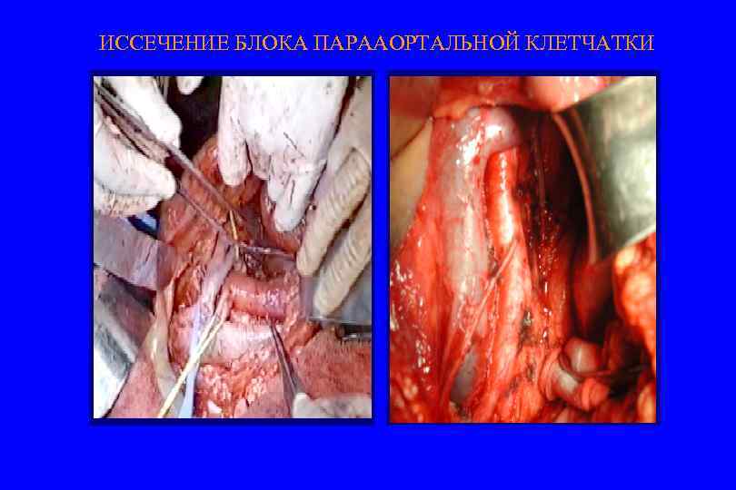 ИССЕЧЕНИЕ БЛОКА ПАРААОРТАЛЬНОЙ КЛЕТЧАТКИ 