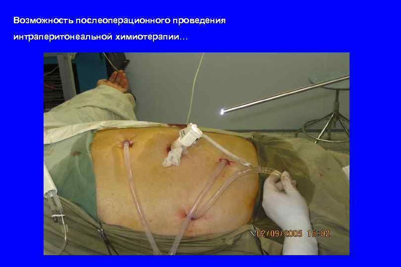 Возможность послеоперационного проведения интраперитонеальной химиотерапии… 