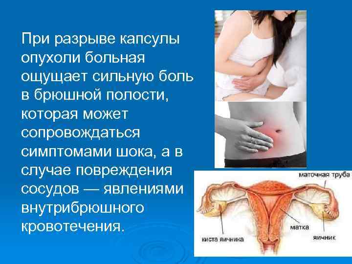 При разрыве капсулы опухоли больная ощущает сильную боль в брюшной полости, которая может сопровождаться